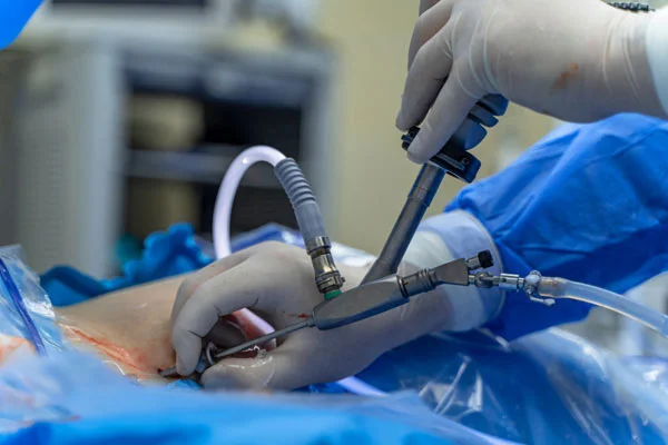 Diagnostic Laparoscopy